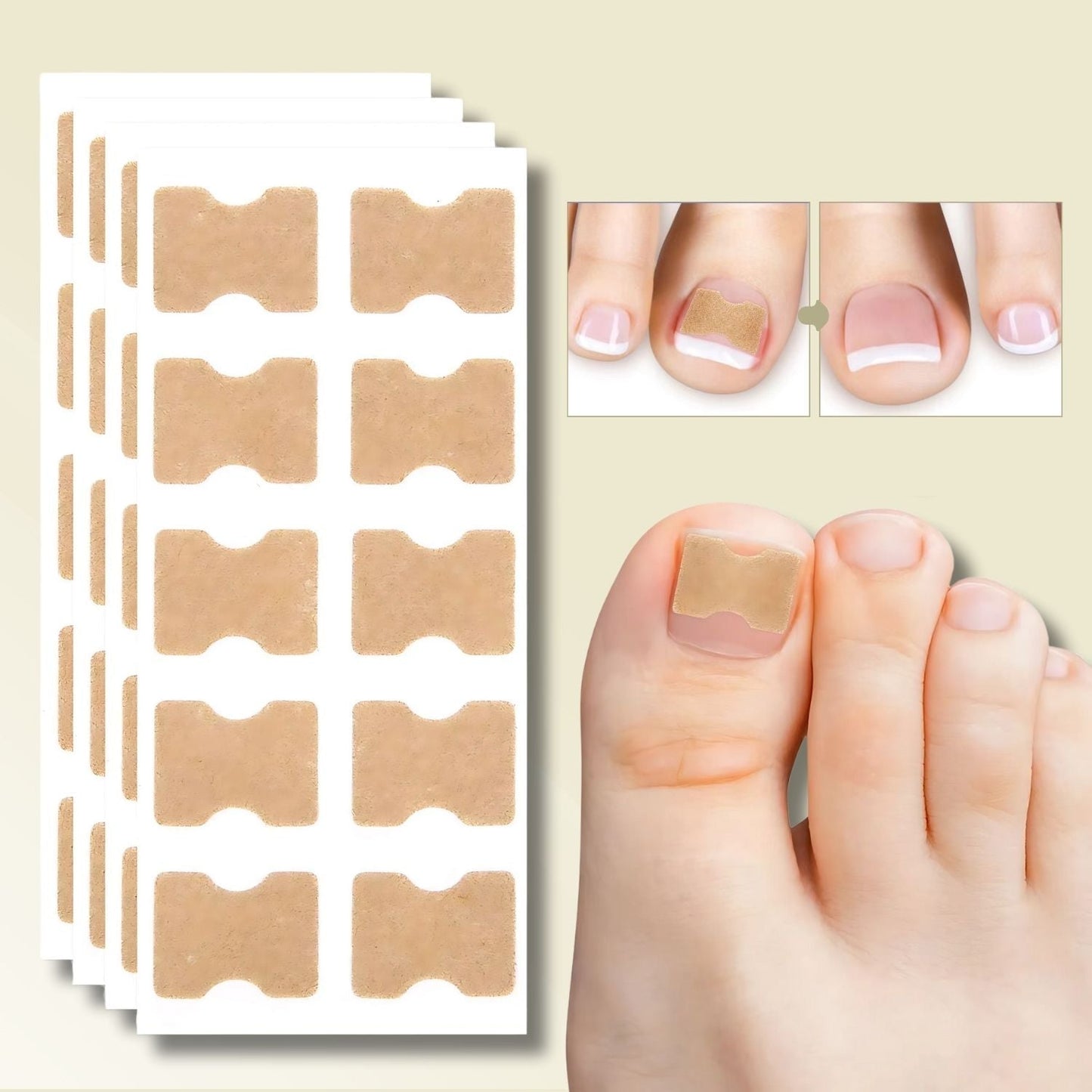Ingrown Toenail Corrector Tool Nail Patches
