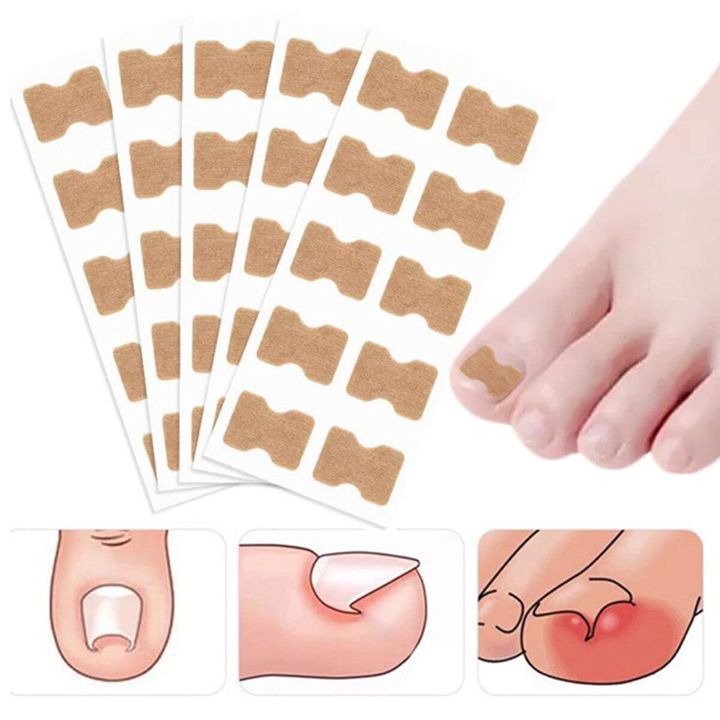 Ingrown Toenail Corrector Tool Nail Patches
