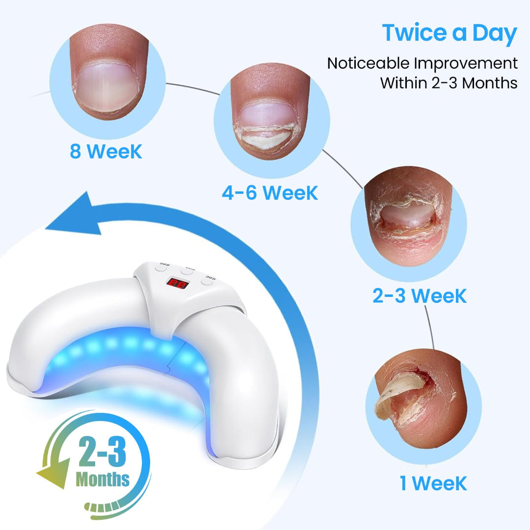 Laser Nail Fungus Removal Home Treatment Device